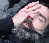 Διαδηλωτής των Κίτρινων Γιλέκων έχασε το μάτι του από χειροβομβίδα! (vid) Διαδηλωτής των Κίτρινων Γιλέκων έχασε το μάτι του από χειροβομβίδα! (vid)