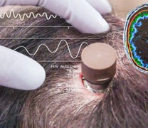 Ξεκίνησε η εμφύτευση τσιπ της Neuralink στον εγκέφαλο των ανθρώπων (vid) Ξεκίνησε η εμφύτευση τσιπ της Neuralink στον εγκέφαλο των ανθρώπων (vid)