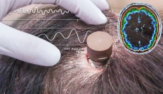 Ξεκίνησε η εμφύτευση τσιπ της Neuralink στον εγκέφαλο των ανθρώπων (vid)