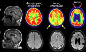 Οι τέσσερις παράγοντες που οδηγούν στην άνοια και πώς να τους σταματήσετε Οι τέσσερις παράγοντες που οδηγούν στην άνοια και πώς να τους σταματήσετε